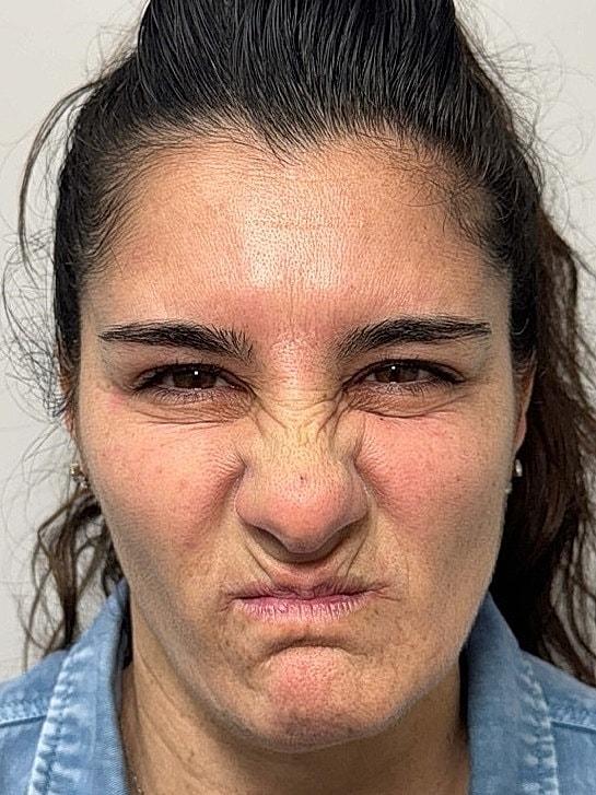 Botox Before & After