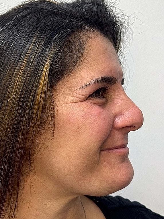 Botox Before & After
