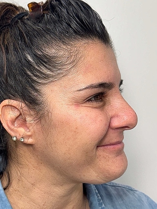 Botox Before & After