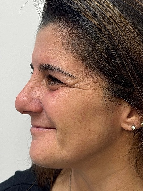 Botox Before & After