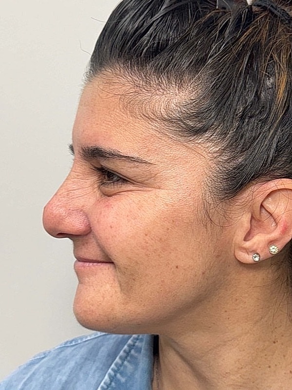 Botox Before & After
