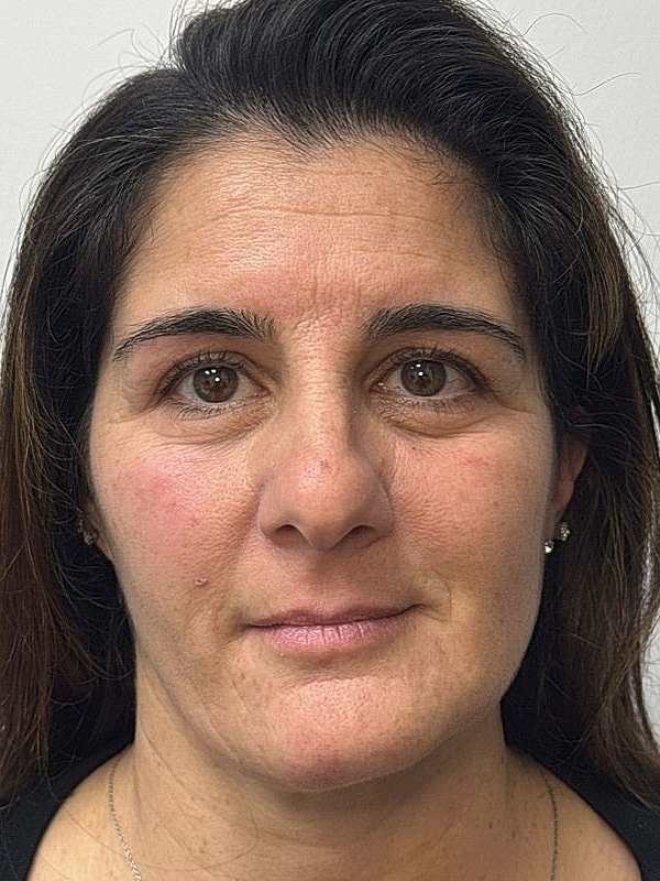 Botox Before & After
