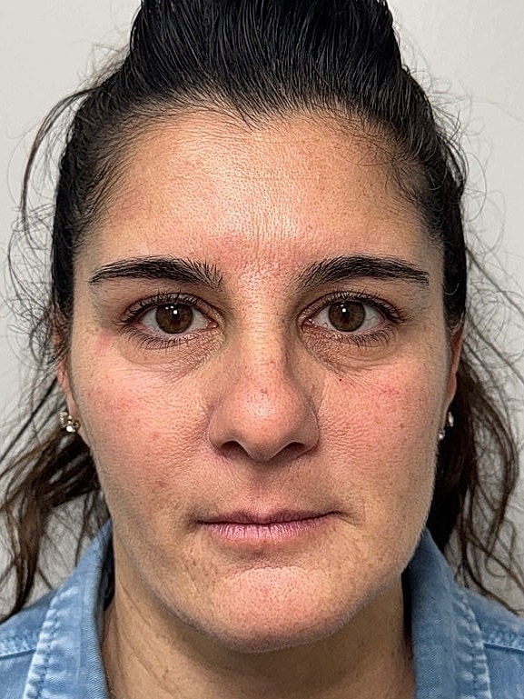 Botox Before & After