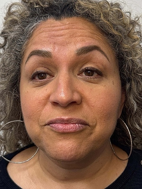 Botox Before & After