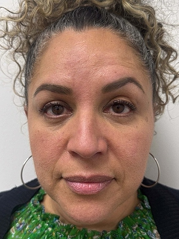 Botox Before & After