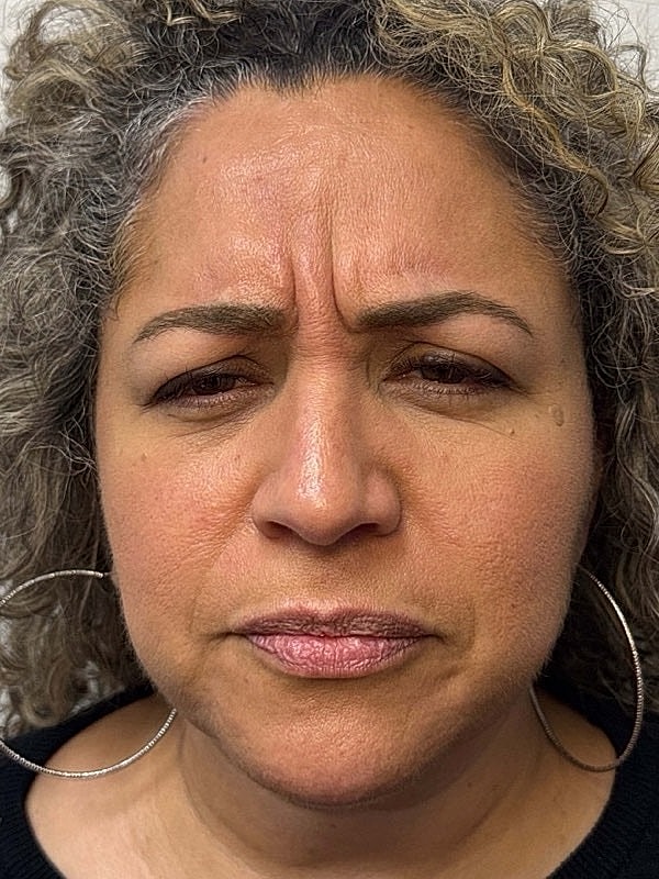 Botox Before & After
