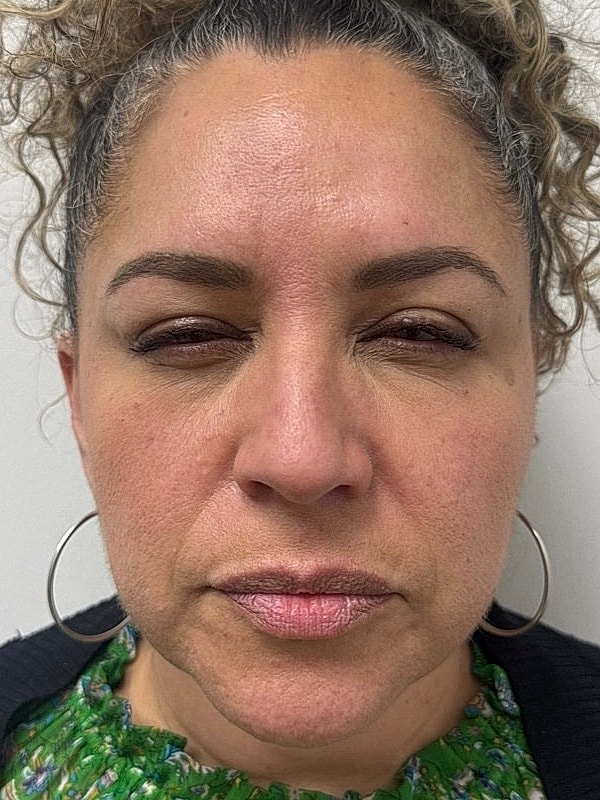 Botox Before & After