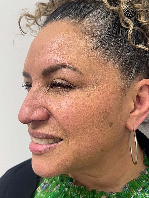 Botox Before & After