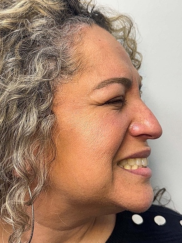 Botox Before & After