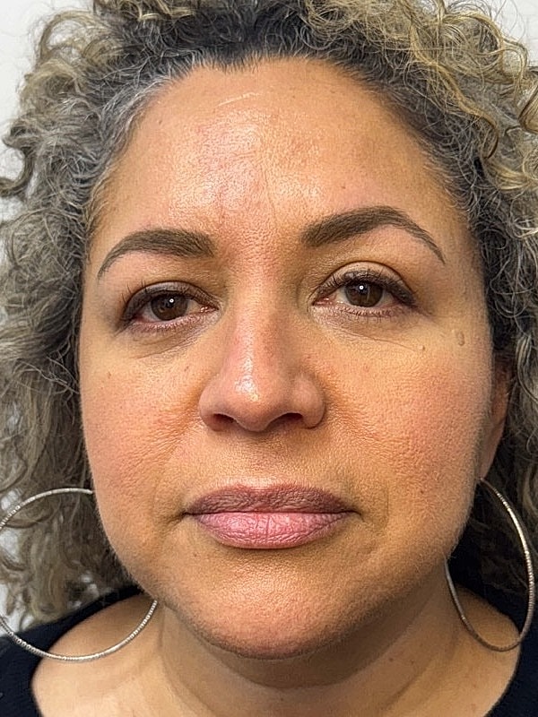 Botox Before & After