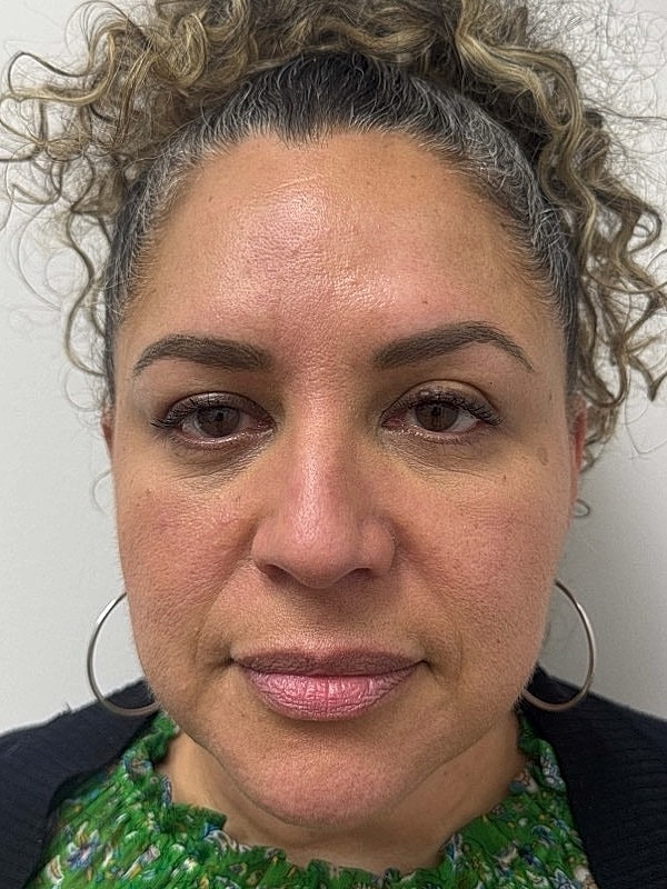Botox Before & After