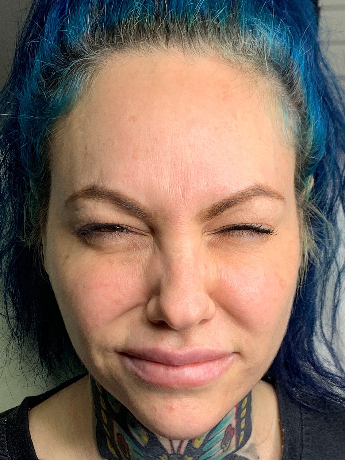 Wrinkle Treatments Before & After