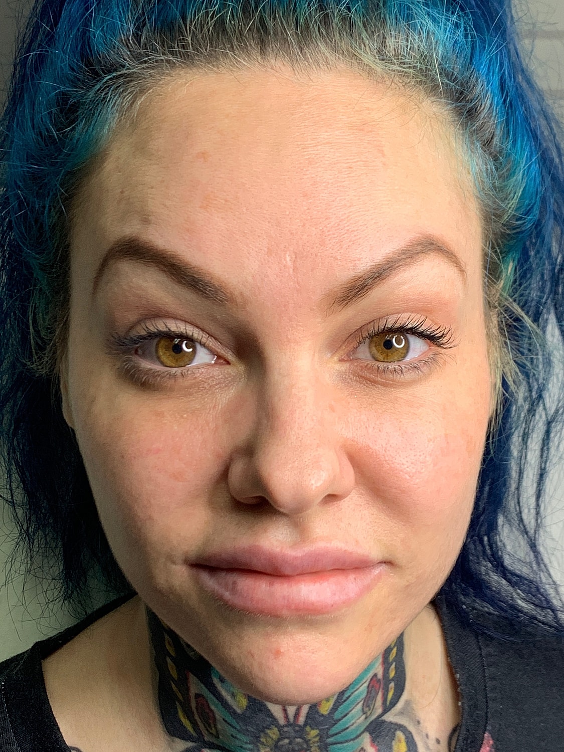 Wrinkle Treatments Before & After