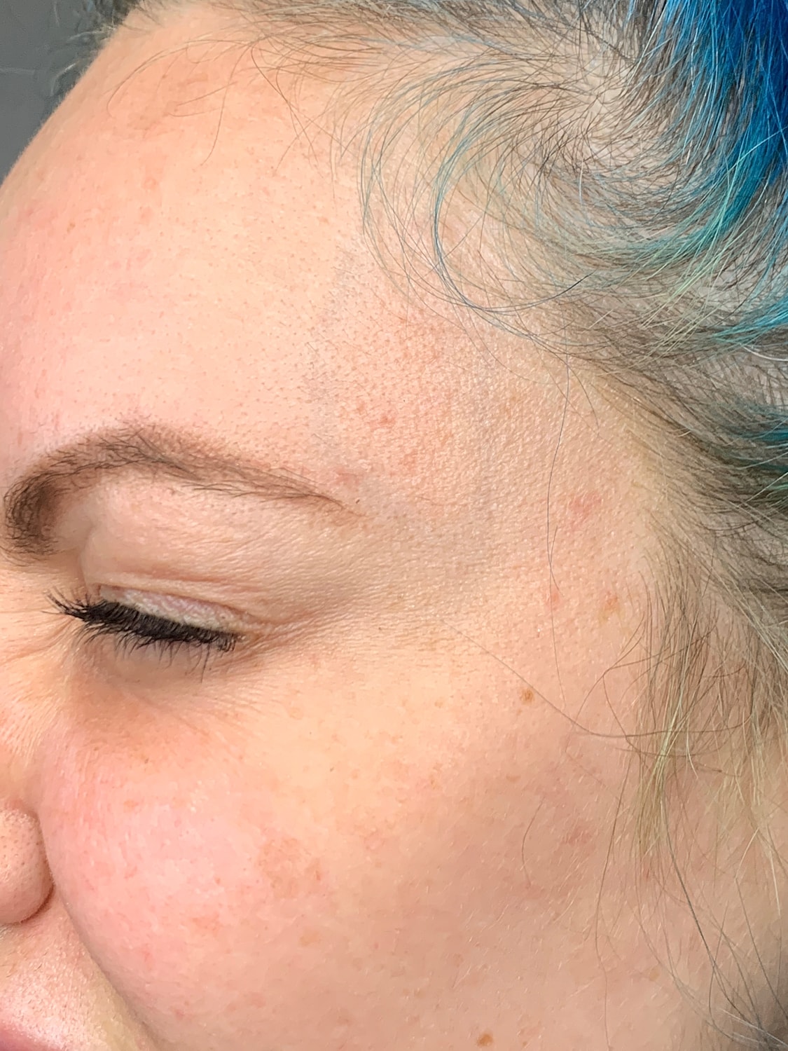 Wrinkle Treatments Before & After