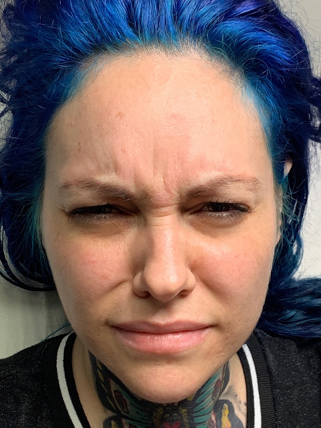Wrinkle Treatments Before & After
