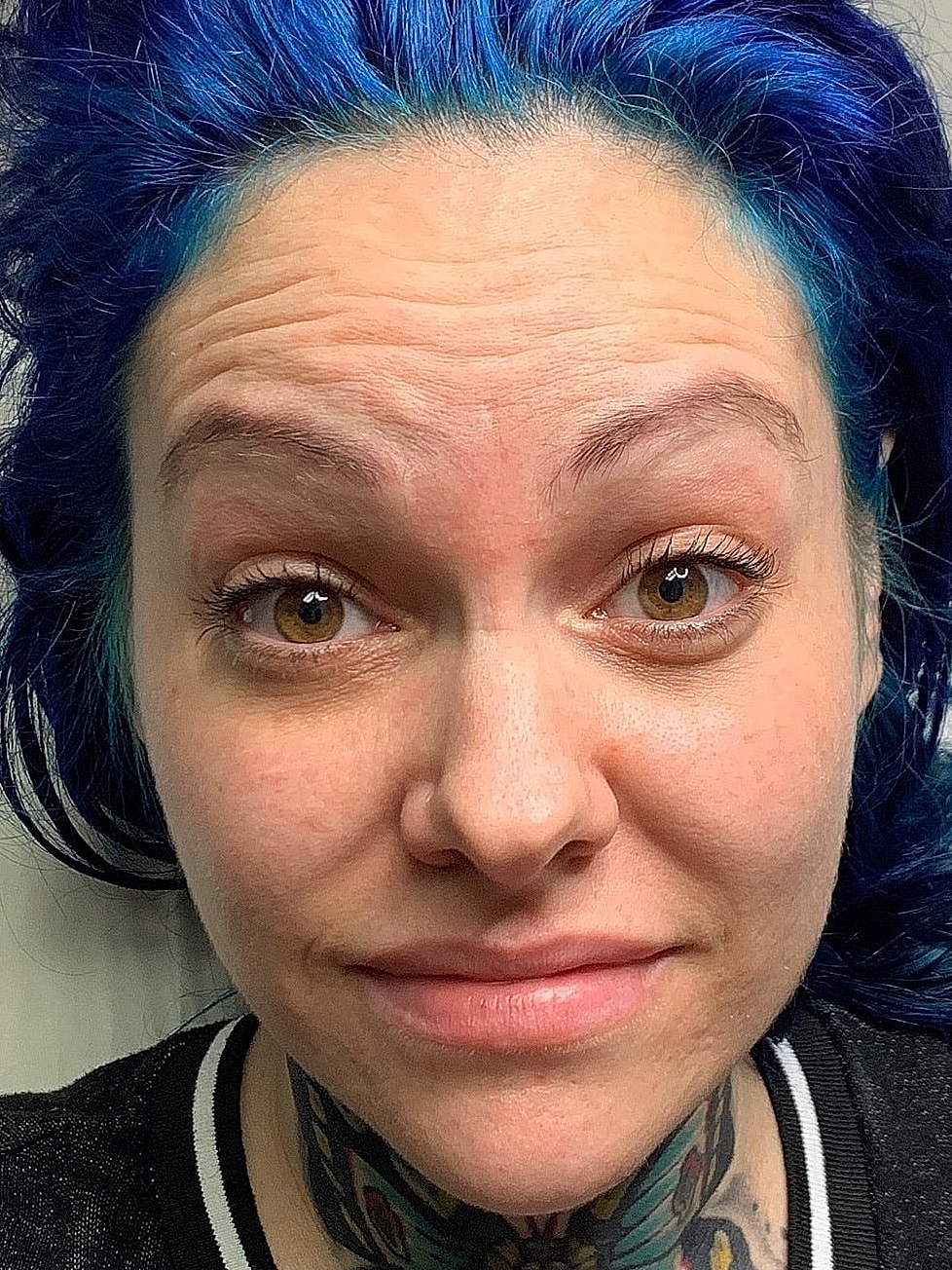 Wrinkle Treatments Before & After