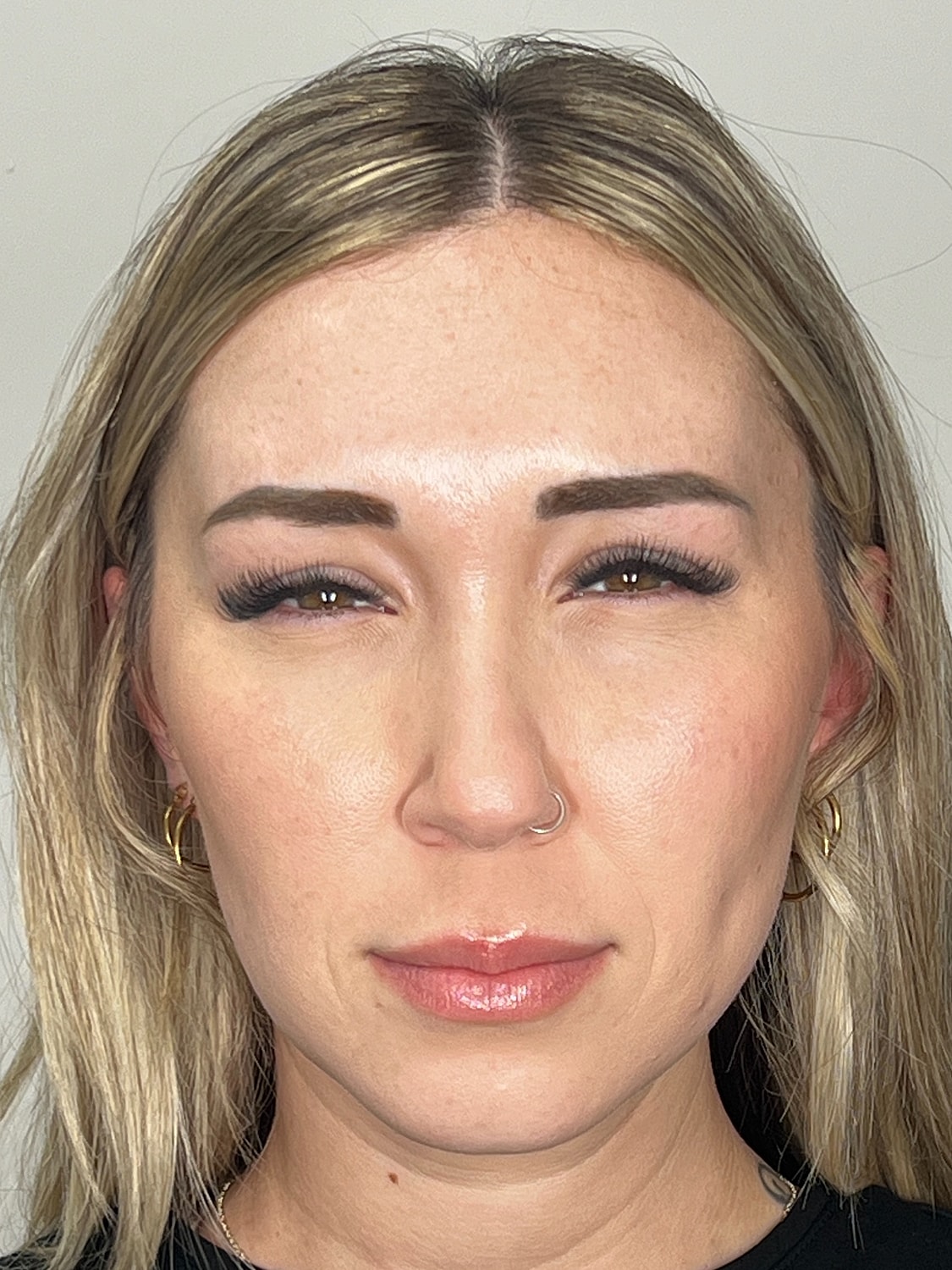 Wrinkle Treatments Before & After