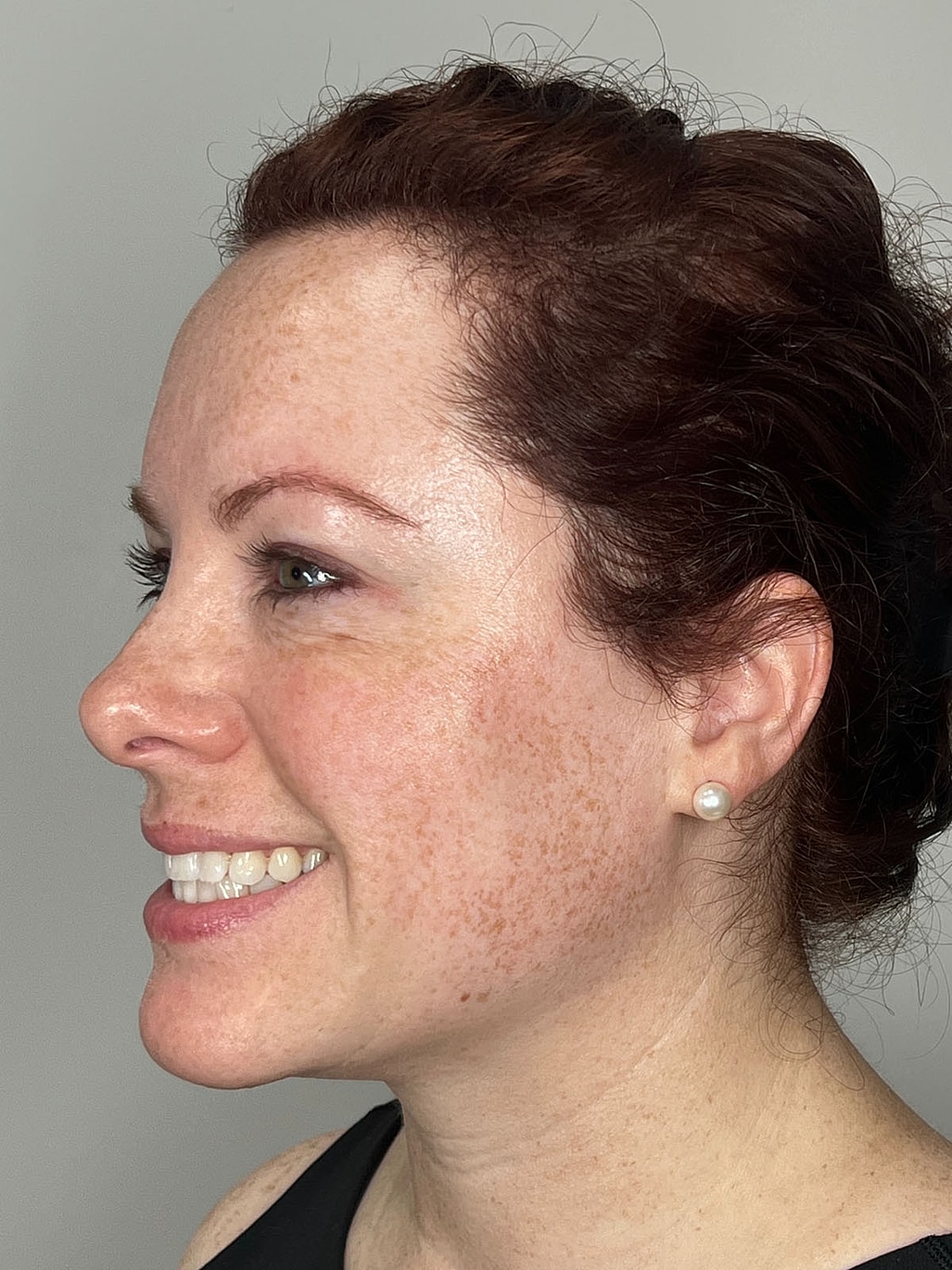 Wrinkle Treatments Before & After