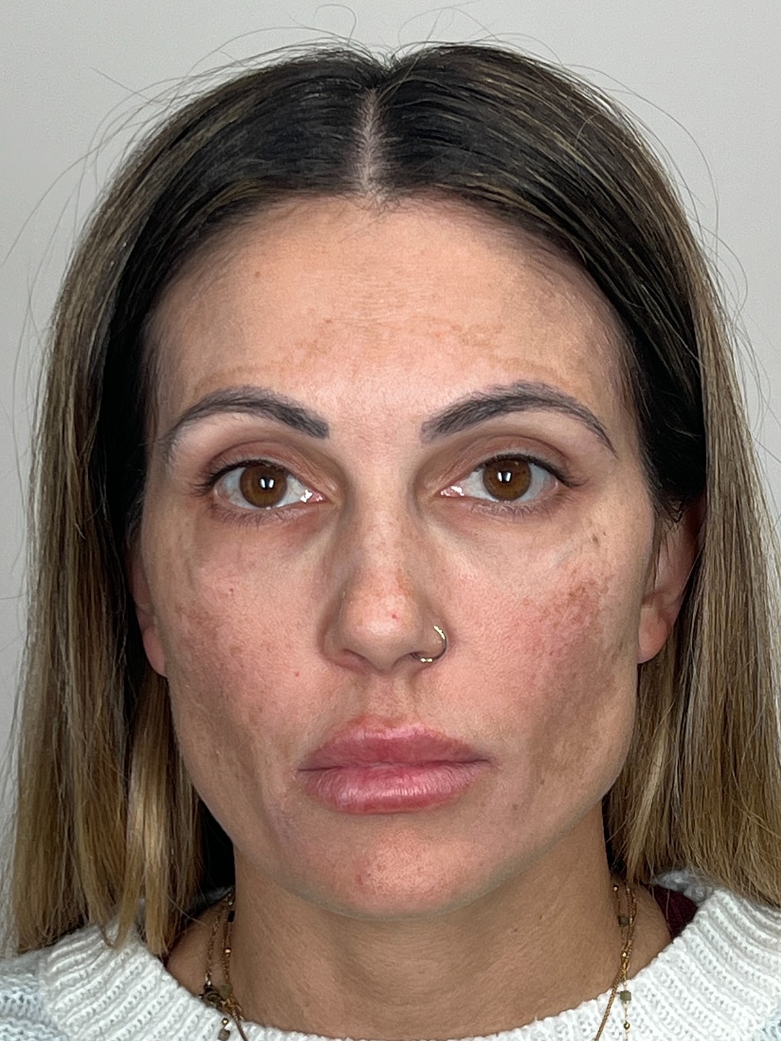 Wrinkle Treatments Before & After