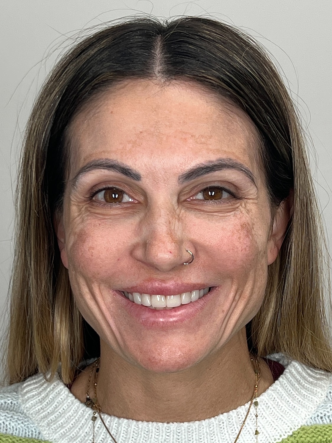 Wrinkle Treatments Before & After
