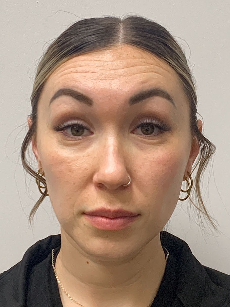 Wrinkle Treatments Before & After