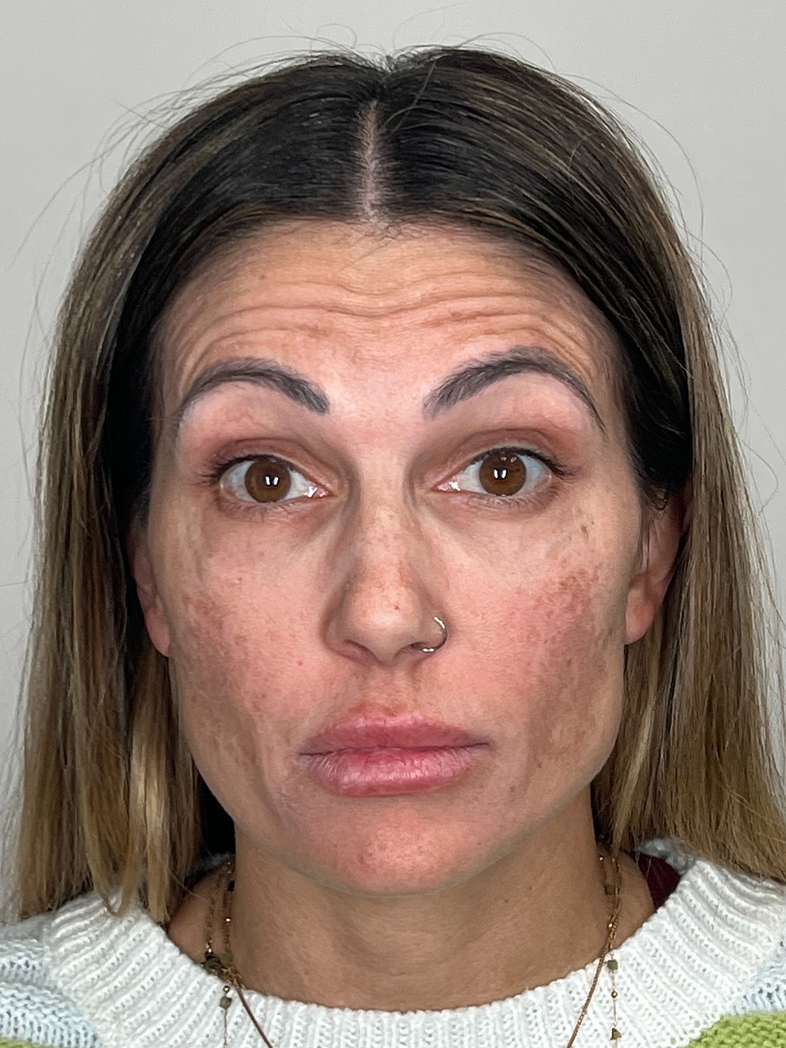 Wrinkle Treatments Before & After
