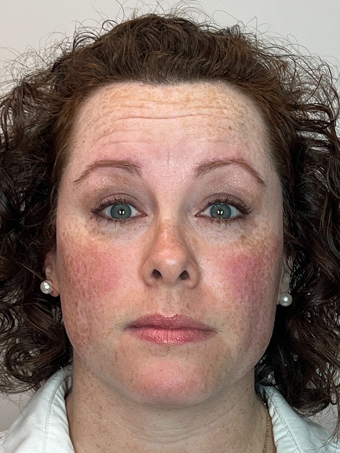 Wrinkle Treatments Before & After