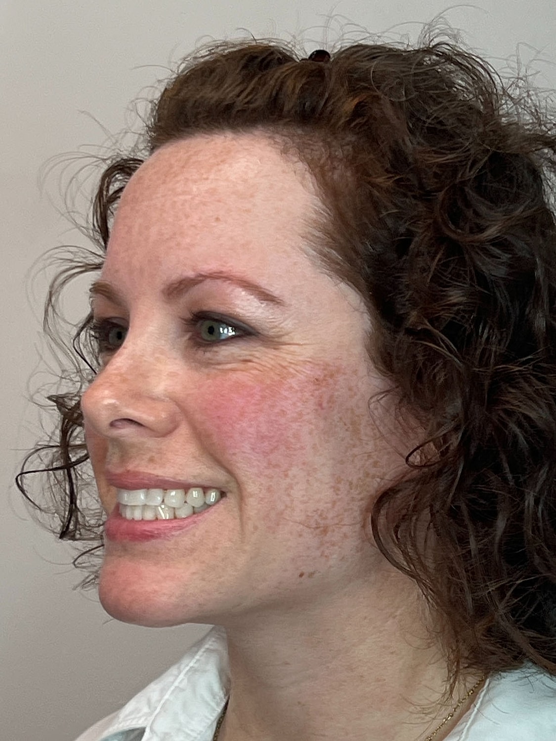 Wrinkle Treatments Before & After