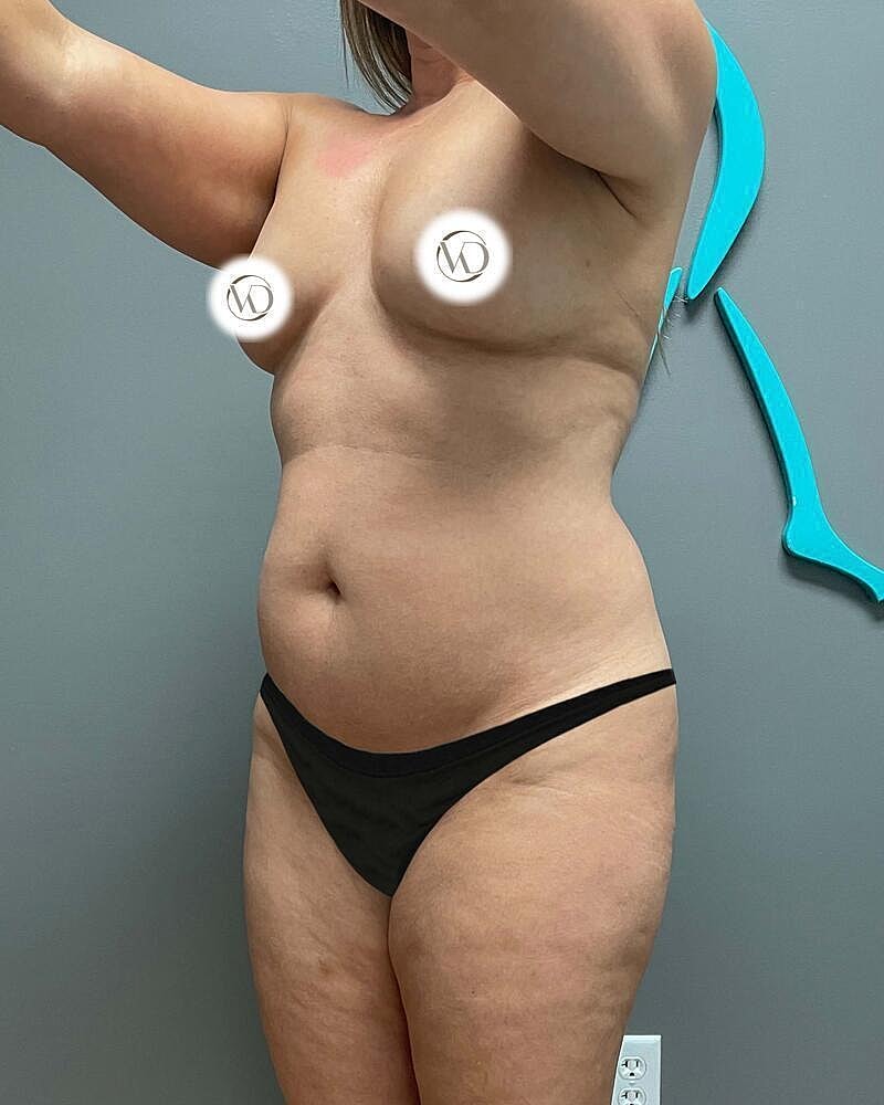 Liposuction Midsection Before & After