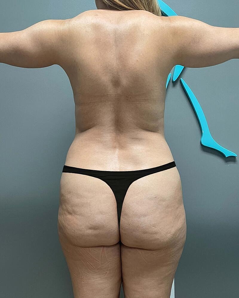Liposuction Midsection Before & After