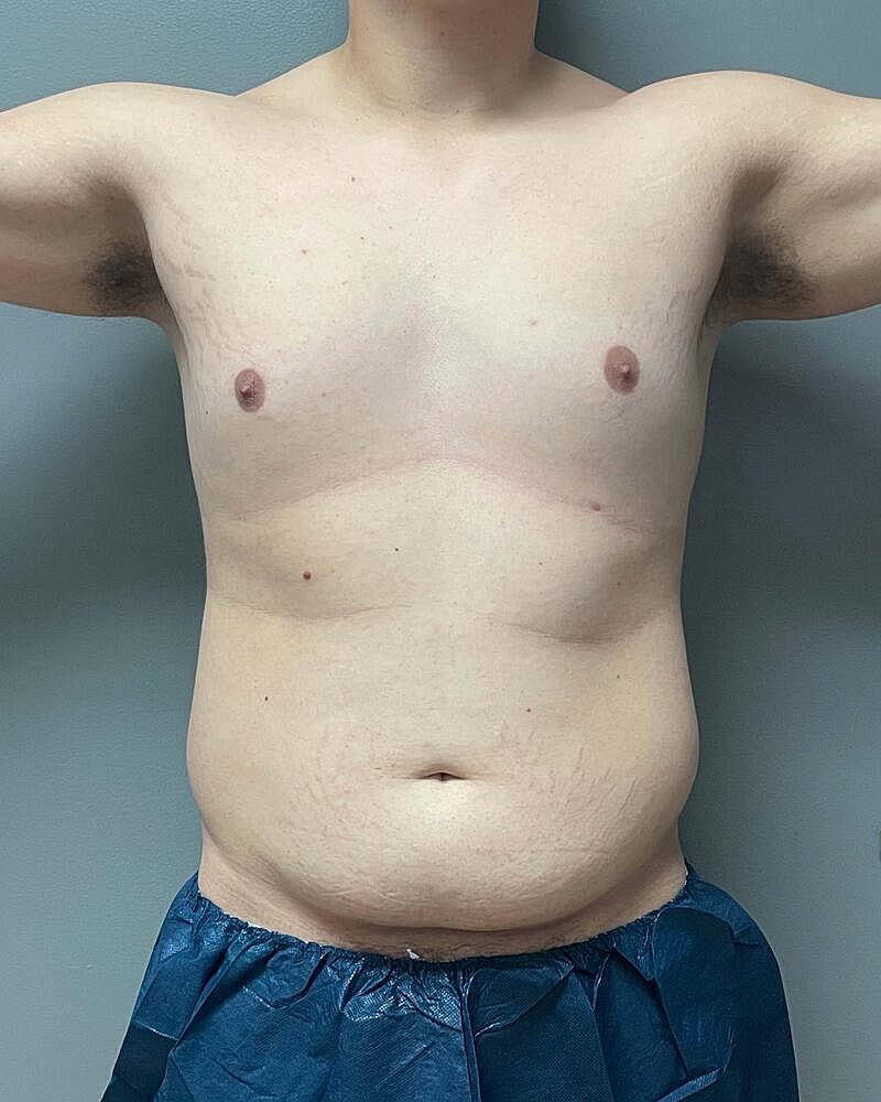 Liposuction Midsection Before & After