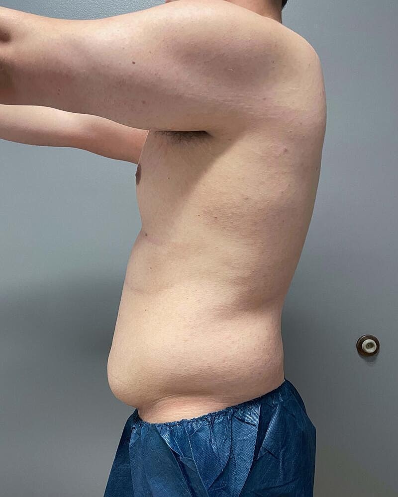 Liposuction Midsection Before & After