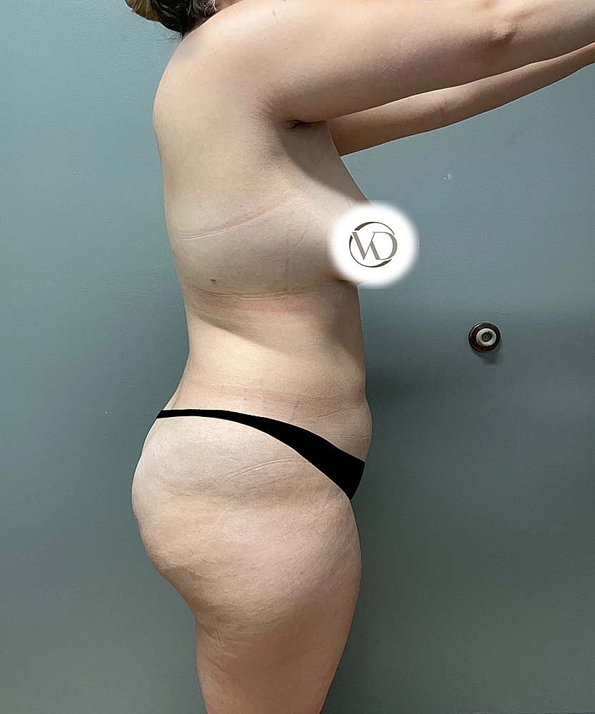 Liposuction Midsection Before & After