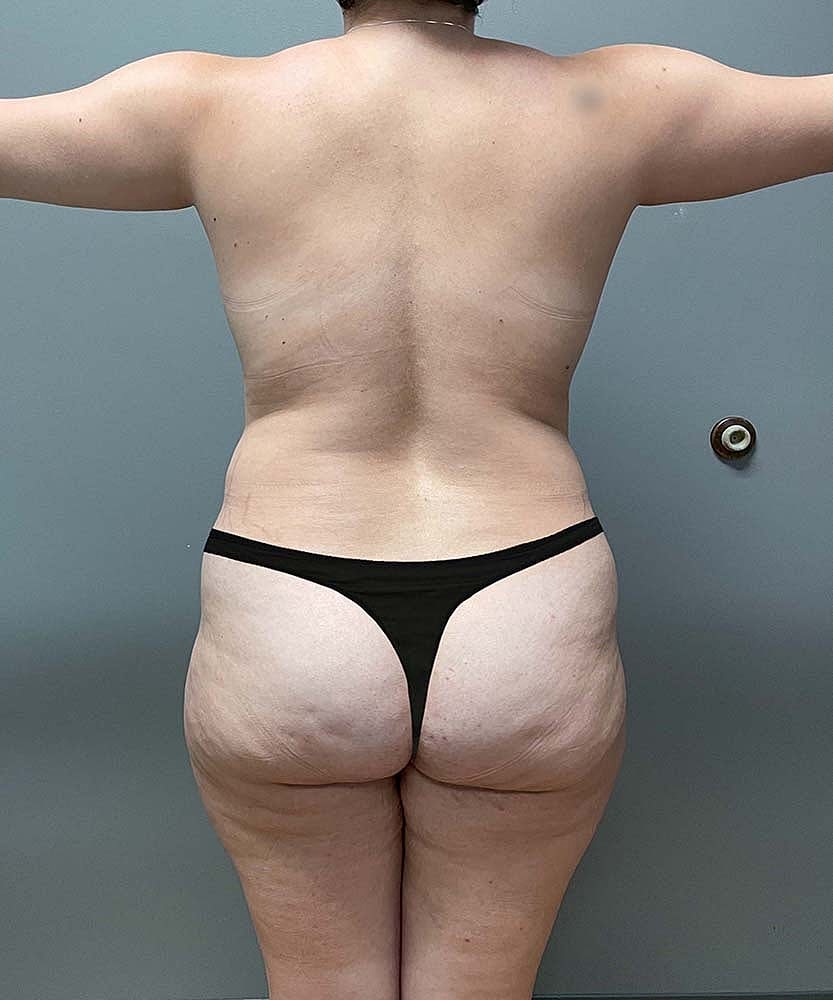 Liposuction Midsection Before & After