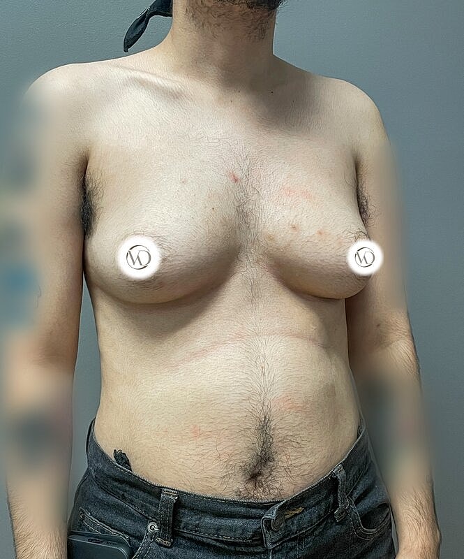 Ftm Top Surgery Before & After