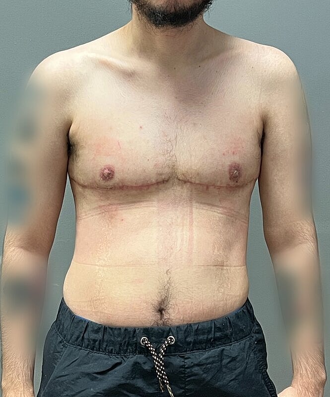 Ftm Top Surgery Before & After
