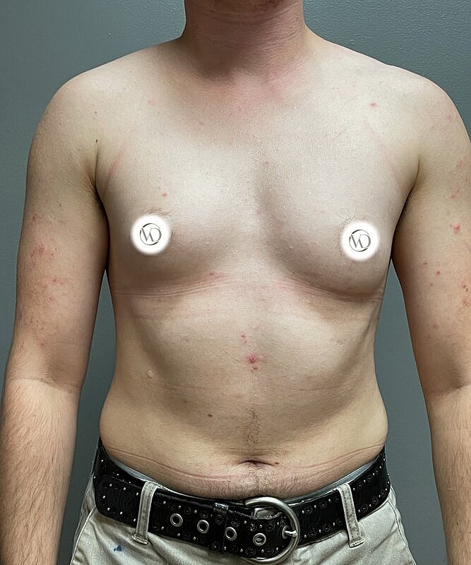 Ftm Top Surgery Before & After