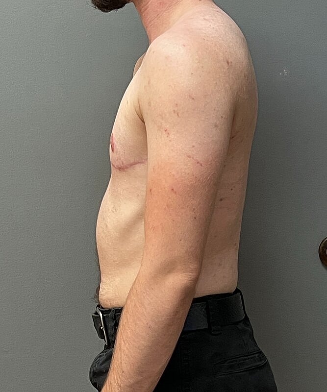 Ftm Top Surgery Before & After