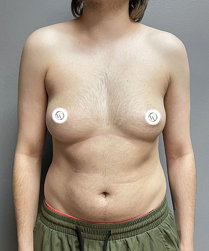 Ftm Top Surgery Before & After