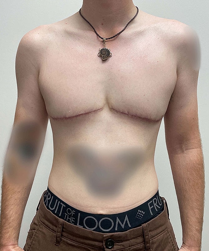 Ftm Top Surgery Before & After
