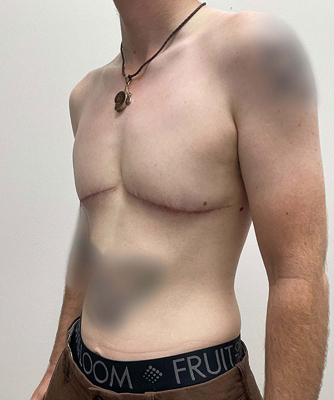 Ftm Top Surgery Before & After