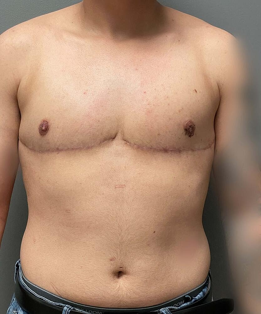 Ftm Top Surgery Before & After