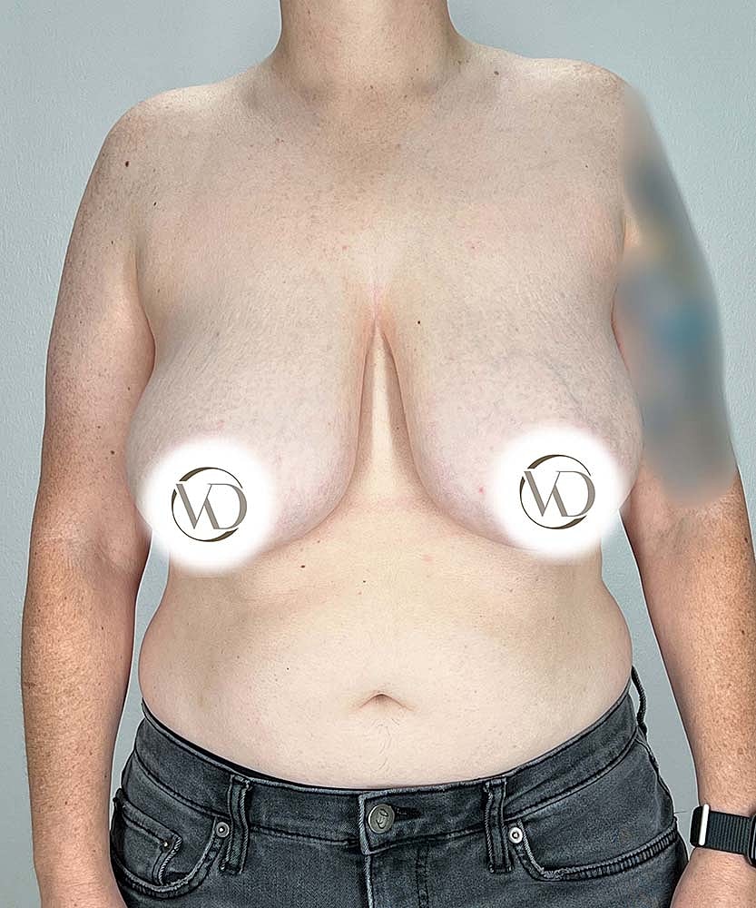 Ftm Top Surgery Before & After