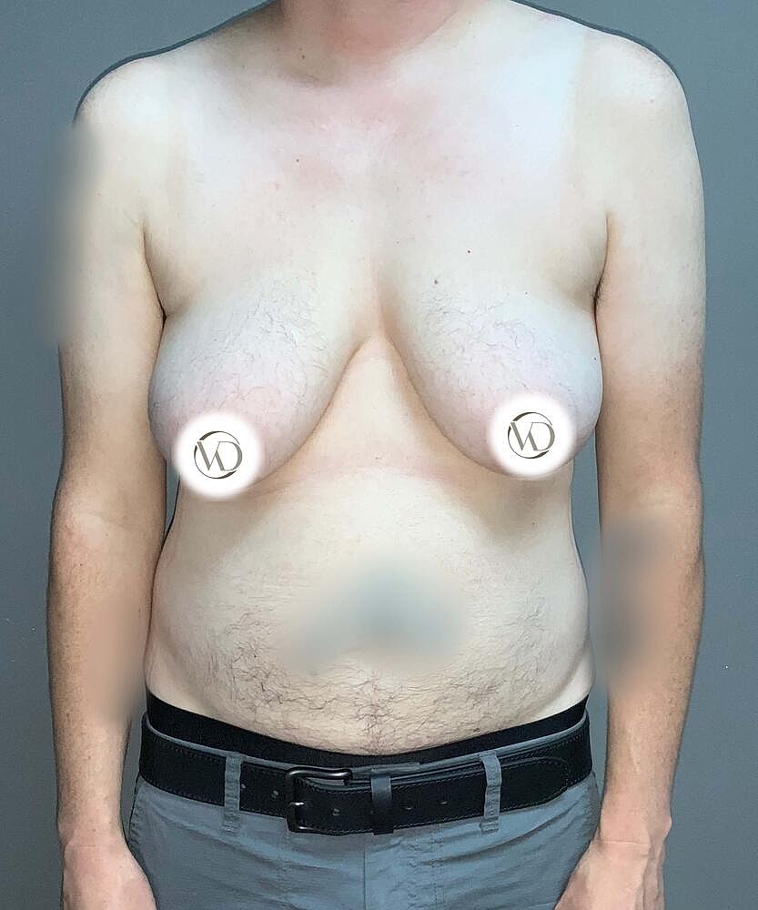Ftm Top Surgery Before & After
