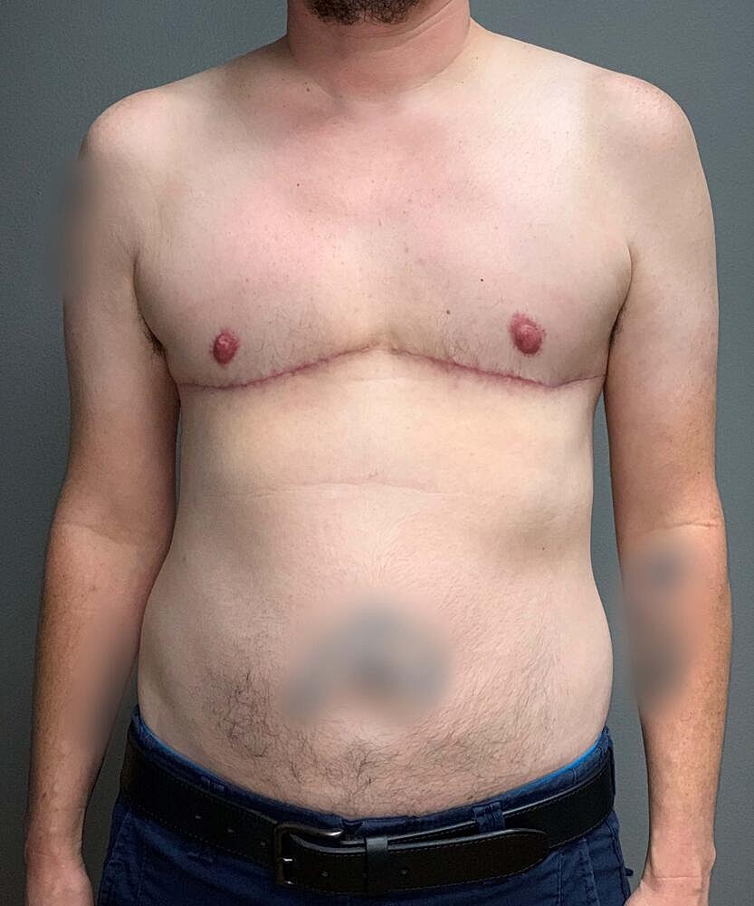 Ftm Top Surgery Before & After