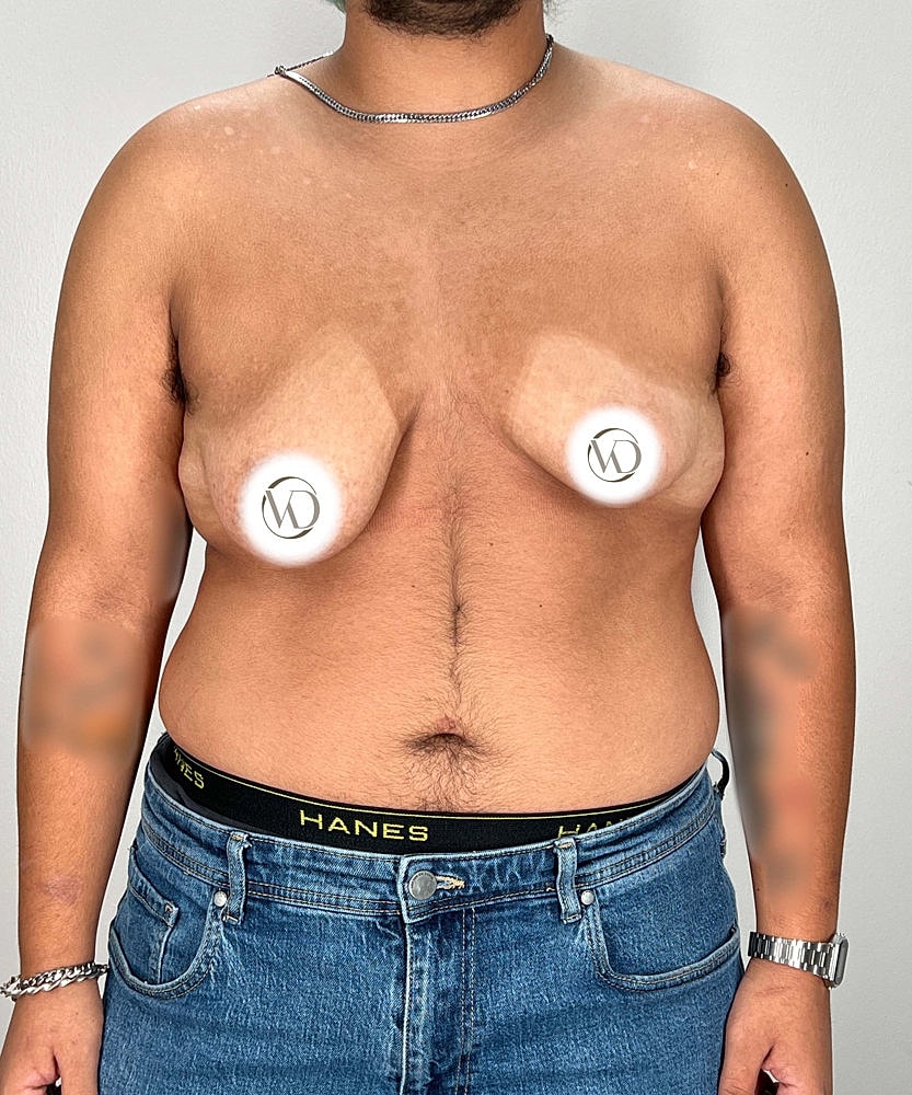 Ftm Top Surgery Before & After