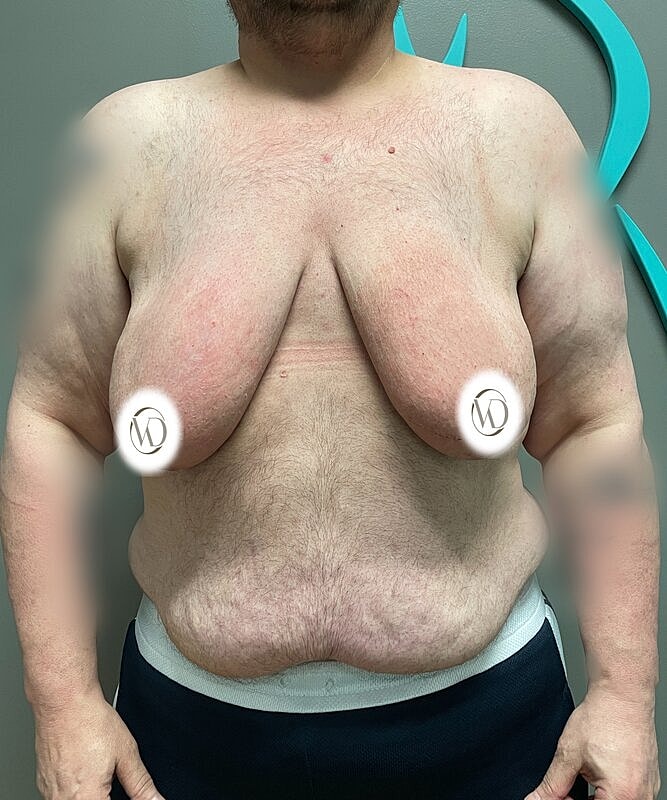 Ftm Top Surgery Before & After