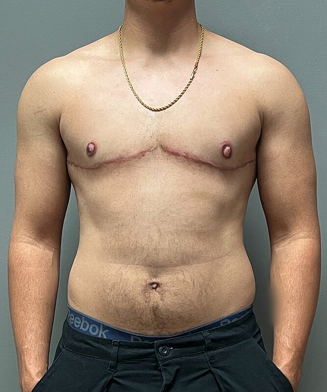 Ftm Top Surgery Before & After