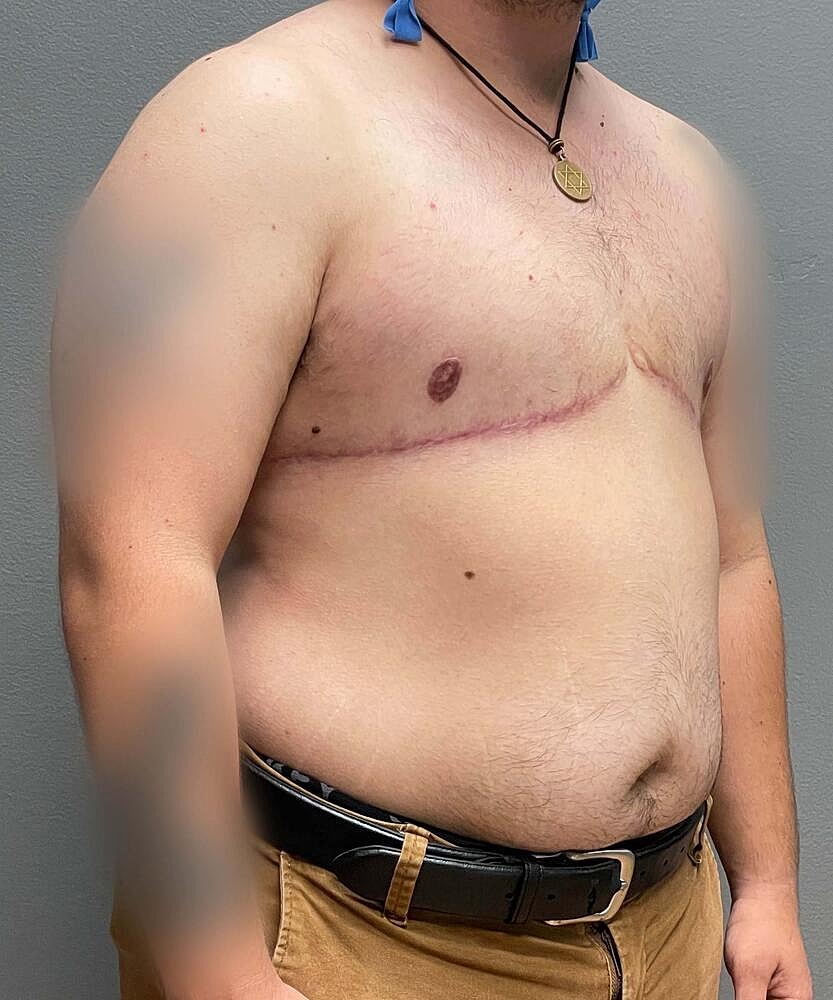 Ftm Top Surgery Before & After