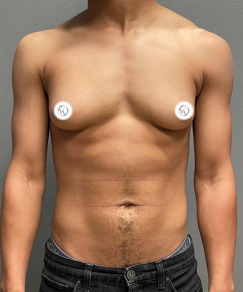 Ftm Top Surgery Before & After